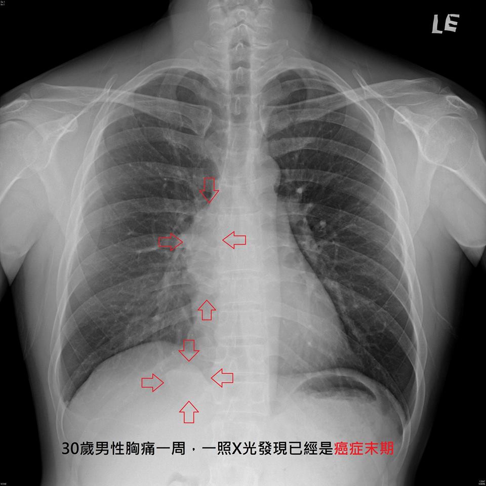 台30岁男末期肺癌不敢请假 医生心疼:你的生命在倒数该罢工啊
